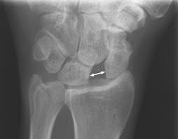 Image result for Scapholunate Dislocation