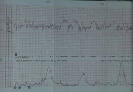 Im normalfall wird ein ctg in der 30. Ctg Bilder Mit Wehen Drauf April 2014 Babyclub Seite 8 Babycenter