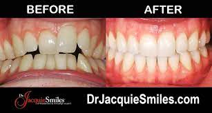 Invisalign Before And After Photos Of Nyc Patients Invisalign Invisalign Hacks Patient