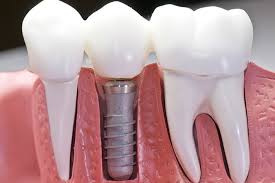 How much do dentures cost? How Much Do Dental Implants Cost In Mesa Eastport Dental