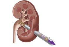 Kidney Stone Surgery Best Surgeon In Bhopal Kidney Stones Kidney Urinary Tract