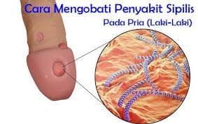 Maybe you would like to learn more about one of these? Cara Penularan Penyakit Raja Singa Ciri Dan Gejala Sifilis Obat Sipilis Infeksi Sipilis Luka Pada Lingkaran Kencing Terasa Panas