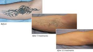 Now available on our website and in all central. Tattoo Removal Before After Visual Results Dekalaser