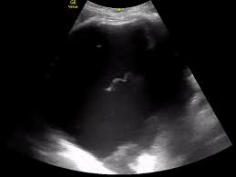Effusions are dependent due to gravity so collect caudad and posteriorly. Pleural Effusion With Lung Worms Jorge Short Md Madrid Spain Everyday Ultrasound