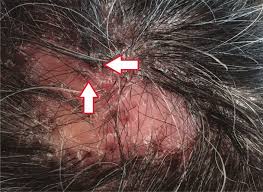 During the resting phase, the stem cells are quiescent and hairs shed more easily. Cicatricial Alopecia With Tufted Folliculitis Download Scientific Diagram