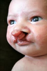 Image result for Cleft Lip