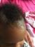 Cradle Cap On Babies