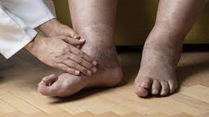 Keluar darah hitam kaki sakit tapak kaki sakit. Ciri Ciri Kaki Bengkak Karena Gagal Jantung