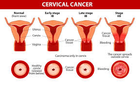 Cervical cancer presents a special challenge because you may not notice any signs or symptoms, especially when the condition is in its earliest stages. Cervical Cancer Victory Brokerage Inc Helping Agents Write Life Insurance