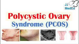 Pcos is constantly being overlooked despite the fact that it's the most common endocrine disorder in women of childbearing ages. Polycystic Ovary Syndrome Pcos Causes Risks And Treatments Youtube
