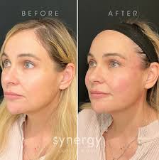 Welcome to ITB, Arianna! 🎉 Meet Arianna! Arianna is a nurse practitioner  injector here at Synergy Face & Body. After two amazing years, she's  excited to announce her transition from Synergy Cary