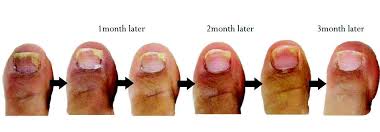 Image result for onychomycosis