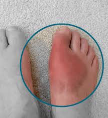 Image result for diabetic toes