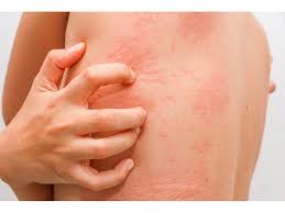 Image result for dermatitis contacta children