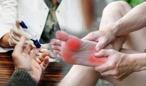 Symptoms of diabetes on your feet. Type 2 Diabetes Neuropathy Is A Dangerous Condition In Your Feet Due To High Blood Sugar Express Co Uk