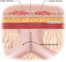 Robotic feeding jejunostomy performed during ivor lewis esophagectomy. Jejunostomy Tube Abdominal Key