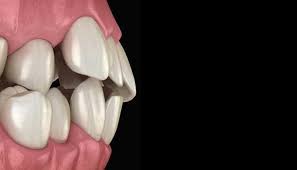 Image result for Occlusal