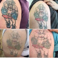 Laser tattoo removal in bracknell, berkshire. Pin On Before After Photos Picosure Laser Tattoo Removal