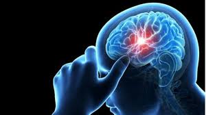 Se è invece superiore a 7 mm è generalmente da trattare. Sai Cos E Un Aneurisma Cerebrale Scopri Come Puoi Prevedere Il Pericolo Prima Che Sia Troppo Tardi
