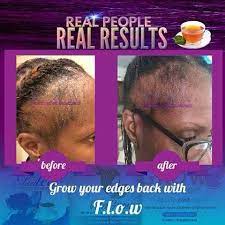 If You Have Missing Edges Balding Dry Brittle Hair Ends Contact Me To Get Your Free Healthy Hair Goal Consul Healthy Hair Journey Real People Grow Hair Faster