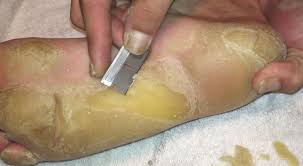 After you exfoliate your feet, rinse clean, then dry and apply a thick layer of foot cream. Stomach Churning Video Shows A Man Hacking A Giant Callus Off His Foot With A Razor Blade