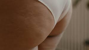 Julesboringlife: Kritik für Influencerin nach Cellulite-Behandlung