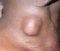 A lump in the front of the neck, near the adam's apple Thyroid Cancer Types Management Teachmesurgery