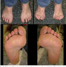Functional hallux rigidus and the Achilles-calcaneus-plantar system.