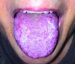 Image result for lichen planus on tongue)