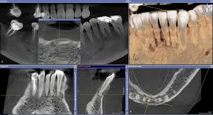 The correct answer is a. Cemento Osseous Dysplasia Radiology Case Radiopaedia Org