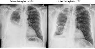 Pleural effusions accompany a wide variety of disorders of the lung, pleura, and systemic disorders. Complications Of Indwelling Pleural Catheter Use And Their Management Bmj Open Respiratory Research