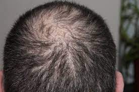 Unlike other organs, low oxygen levels can weaken your hair follicles and eventually turn them into dormant follicles. Vitamins For Hair Loss Hair Loss Due To Vitamin Deficiency Vitamin Nutrition