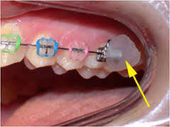 Your orthodontist will most likely send you home from your appointment with orthodontic wax, which is a special wax that protects the inside of your lips and cheeks and your gums from the brackets of the braces. Wax On Wax Off Marda Loop Braces Braces And Invisalign For All Ages In Calgary Ab