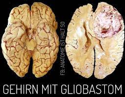 Anatomie Ist Halt So Das Glioblastom Auch Glioblastoma Multiforme Ist Der Haufigste Bosartige Hirneigene Tumor Bei Erwachsenen Das Glioblastom Weist Feingewebliche Ahnlichkeiten Mit Den Gliazellen Des Gehirns Auf Und Wird Aufgrund