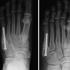 In most cases, a jones fracture is attributed to a twisting younger people are known to heal faster from bone injuries. Pdf Fifth Metatarsal Fractures In The Athlete Evidence For Management