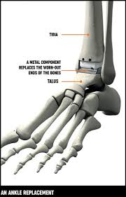 How long do bones take to heal after an ankle break? Foot And Ankle Surgery Treatment Options Versus Arthritis