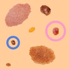 Ignoring the early warning signs and symptoms of any skin … Guide To Moles Skin Cancer How To Tell If A Mole Is Cancerous