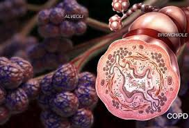 Copd is a progressive disease, meaning it typically worsens over time. Copd Lung Symptoms Diagnosis Treatment