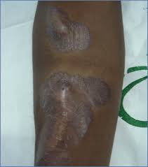 Image result for koebner phenomenon psoriasis