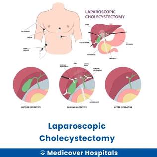 Disposición Quirúrgica Y Abordaje Laparoscópico Para Colecistectomía, Generada Por Ia