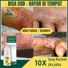 Orang yang bergaul rapat dan tinggal bersama orang yang telah dijangkiti kudis buta harus dirawat pada masa yang sama. Obat Kudis Scabies Obat Kudis Di Kaki Kudis Di Kepala Kudis Di Tangan Obat Pembasmi Kudis Skabies Kutu Scabies Gigitan Tungau Obat Kudis Dan Gatal Kudis Kurap Kudis Buta Kudisan Untuk