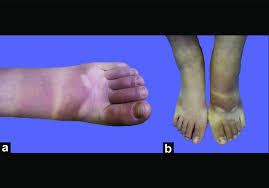Image result for brown patches on the feet