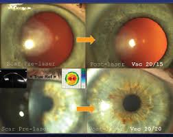 Corneal Opacity - Cancer Therapy Advisor