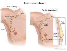 A painless lump or thickening in your. Male Breast Cancer Awareness Symptoms Breast Lymph Nodes Picture Of Breast Cancer Cleveland Oh University Hospitals
