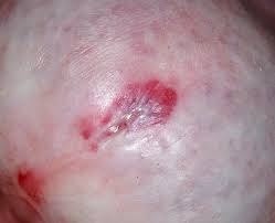 Image result for balanoposthitis