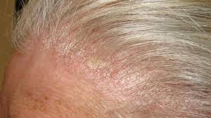 Dandruff is a common scalp condition in which small pieces of dry skin flake for example, some dandruff shampoos require that you lather the shampoo into the hair and scalp. Dandruff Vs Psoriasis How To Tell The Difference