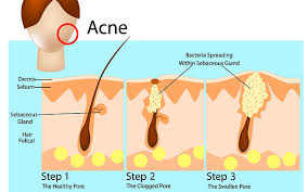 Image result for Sebaceous Gland