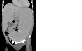 Image result for Splenomegaly
