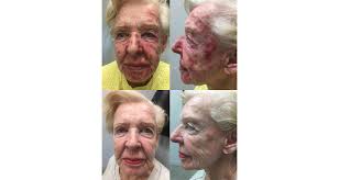 Fluorouracil for skin other names: Before After Dermassociates Rockville U S Dermatology Partners
