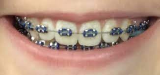 Navy Blue Braces In 2021 Braces Colors Teeth Braces Braces Teeth Colors